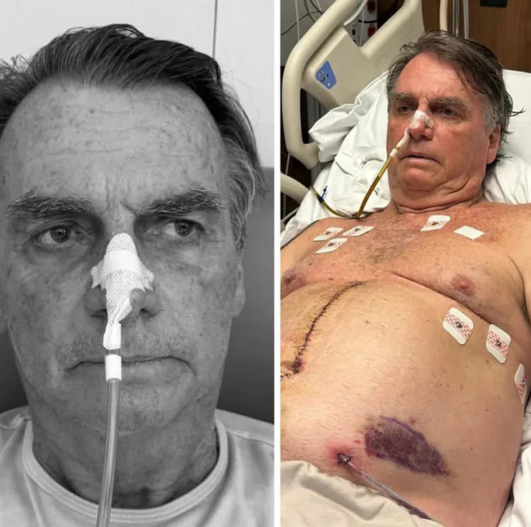 Ex-presidente Jair Bolsonaro tem duas lesões compatíveis com câncer de pele, confirma equipe médica